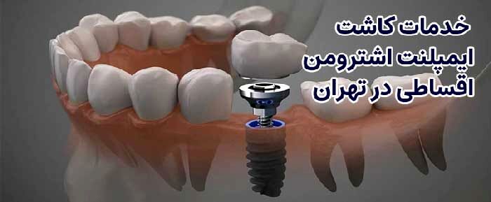 ایمپلنت سوئیسی اشترومن اقساطی در تهران